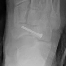 Navicular ORIF